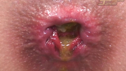 GoGo Japan Scatology Huge syringe in the anus. P1